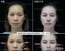 下颚填充整形需多少钱(下颚整形费用)