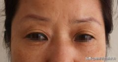 眉毛整形手术要多少钱一次(眉毛整形手术要多少钱一次费用)