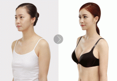 乳腺腺体手术加整形多少钱(乳腺癌整形手术需要多少费用)