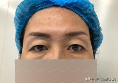 做提眉整形价格多少(整形医院提眉多少钱)