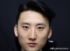 北京鼻翼整形一般多少钱(鼻翼整型价格)