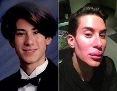 硅胶整形多少钱(隆鼻硅胶多少钱)