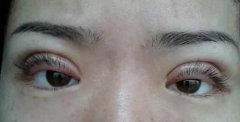 整形眼皮多少钱(整形眼皮多少钱一个)