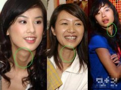 潍坊眼袋整形大概多少钱(潍坊割眼袋)