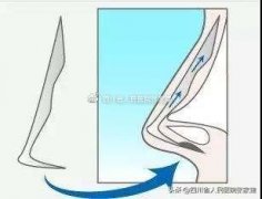 韩国鼻部整形多少钱(韩国鼻子整形价格)