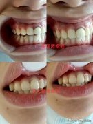 牙齿做整形多少钱(做个牙齿整形需要多少钱)