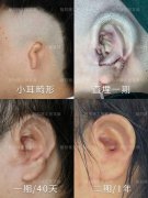 耳朵美容整形手法多少钱(耳朵美容手术多少钱)