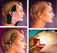 整形整容一般手术多少天(整容手术需要多久)