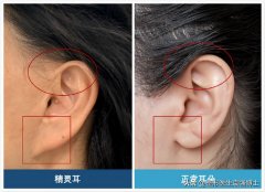 耳朵折叠整形多少钱啊(耳朵折叠整形多少钱啊)