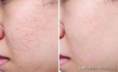 整形祛疤多少钱(面部整容祛疤手术大概多少钱)