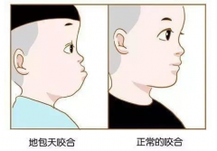 地包天整形大概多少钱(地包天整形多少钱19岁)