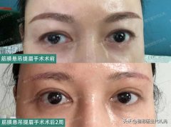 整形提眉得多少钱(提眉毛多少钱)