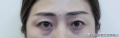 网爆眼部整形费用大概多少(眼部整形需要多少钱 哪里便宜些)