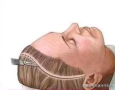 整形额头去皱手术多少钱(面部除皱术要多少钱)