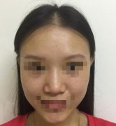 鼻子整形 整形肿多少天