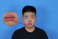 上嘴唇厚突出整形多少钱(嘴唇突出手术多少钱)