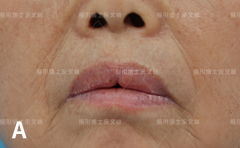嘴唇做整形手术多少钱(嘴唇做整形手术多少钱一次)