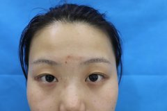 五官综合整形多少钱(整形整脸型多少钱)