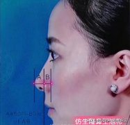 整形鼻部整形手术多少钱(鼻子的整形手术多少钱)