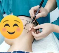 耳朵整形手术要多少钱(耳朵整形费用)