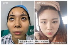 颧骨整形用多少钱(颧骨整形多少钱颧骨缩小术)