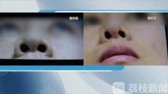 南京鼻子整形需要多少钱(整鼻子大概多少费用南京)