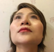 颧骨太宽整形要多少钱呢(颧骨太宽做手术大概多少钱)