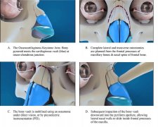 上海ldo整形 学费多少