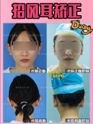 招风耳整形一般多少钱一只(招风耳整形一般多少钱一只)