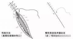美容整形缝针价格多少(美容整形缝针价格多少)