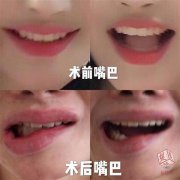 嘴部整形多少天能恢复(嘴角整形恢复期要多久)
