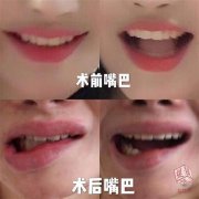 整形嘴唇要多少钱(整形手术嘴唇多少钱)