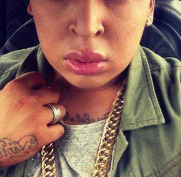 为了追星，男子花费100万元整容50多次，结果整容成了香肠嘴