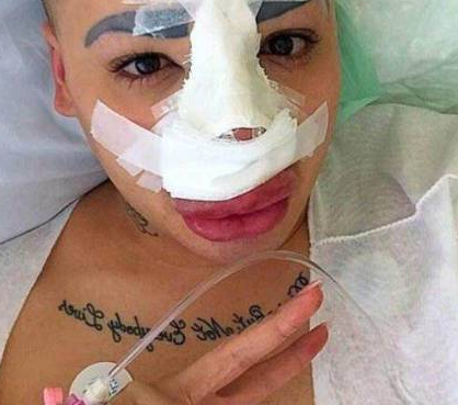 为了追星，男子花费100万元整容50多次，结果整容成了香肠嘴