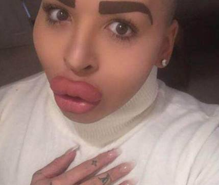 为了追星，男子花费100万元整容50多次，结果整容成了香肠嘴