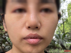 整形鼻子增生多少钱啊(整形鼻子增生多少钱啊医院)