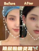 医美整形耳朵要多少钱(医美整形耳朵要多少钱)