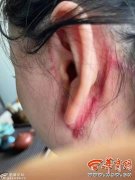 微整形脸上疤痕要多少钱(微整祛疤一般多少钱)