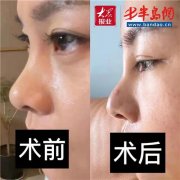 嘴唇突出整形大概多少钱(嘴唇突出整形大概多少钱啊)