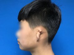 外耳整形费用多少钱(耳朵假体手术多少钱)