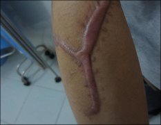 整形祛疤痕调节费用多少(整形祛疤痕调节费用多少钱)