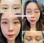 脂肪填充面整形多少钱(面部填充整形多少钱)