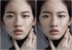 整形面部颧骨突出多少钱(颧骨太突出怎么改良需要多少钱)