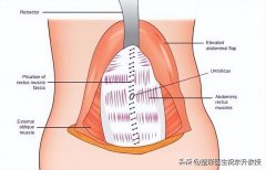 整形腹壁多少钱(腹壁整形要多少钱)
