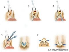 华西整形科隆鼻多少钱(华西整形价格)