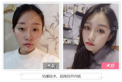 青岛鼻子整形需要多少钱(青岛鼻子整形需要多少钱费用)