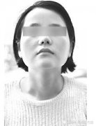 鼻子整容整形多少钱(整形整鼻子大概多少钱)