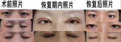 华美做整形多少钱(华美做整容多少钱)