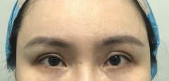 眼窝深整形手术多少钱(深眼窝割双眼皮图片)