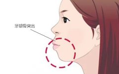 突嘴整形得多少钱(凸嘴整形一般多少钱)